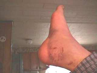 MyFoot5thWeek.jpg (5150 bytes)